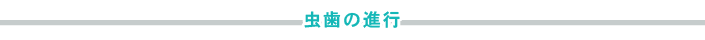 虫歯の進行