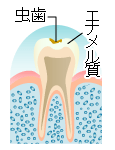 虫歯の進行 C1 エナメル質齲蝕