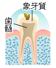 虫歯の進行 C2 象牙質齲蝕