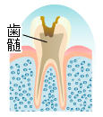 虫歯の進行 C3 歯髄齲蝕