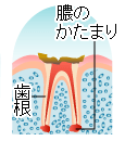 虫歯の進行 C4 歯冠崩壊・残根状態の齲蝕