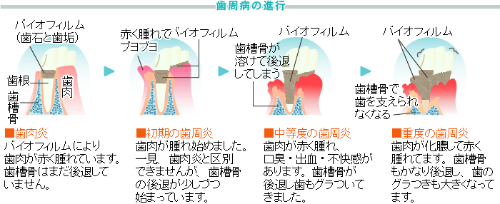 歯周病の症状